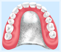自費の入れ歯