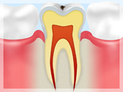 C0【ごく初期の虫歯】