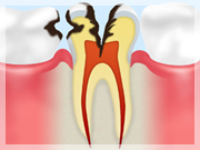 C3【神経まで達した虫歯】