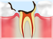C4【歯根まで達した虫歯】